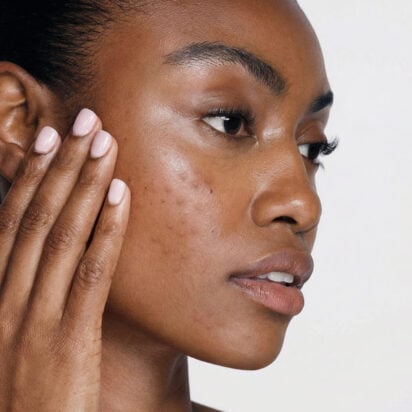 Acne scars: how to get rid of them, what they are, and why they appear